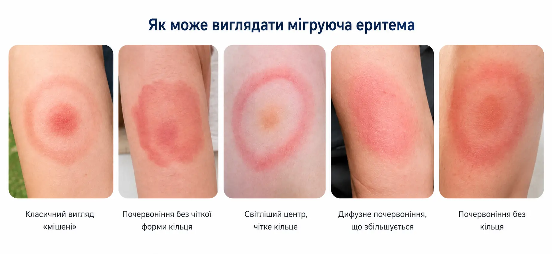 Приклади мігруючої еритеми (раннього прояву хвороби Лайма) різної форми після того, як дитину вкусив кліщ